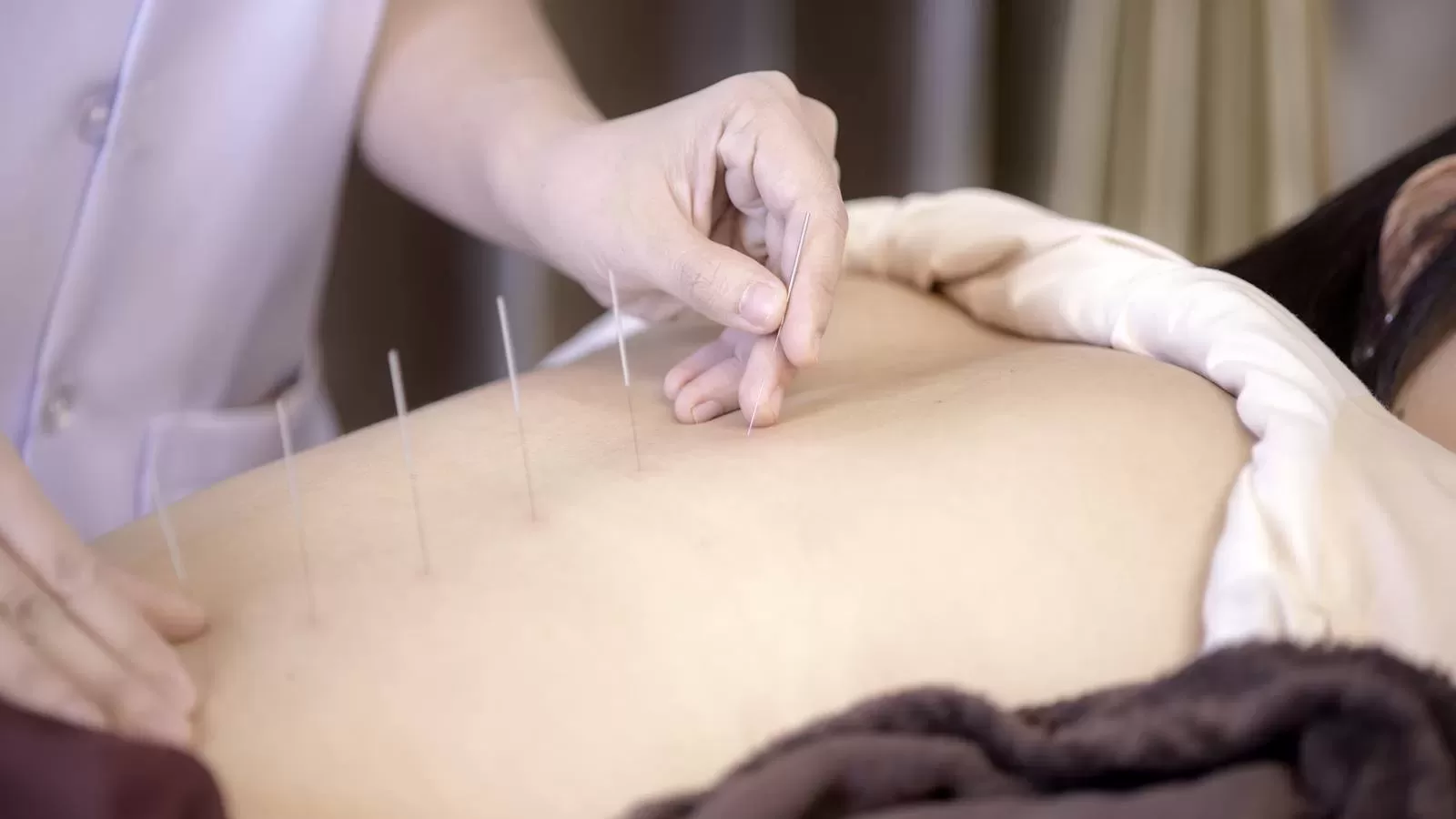 Acupuncture is a Chinese traditional treatment performed by professionals to treat pains in body.