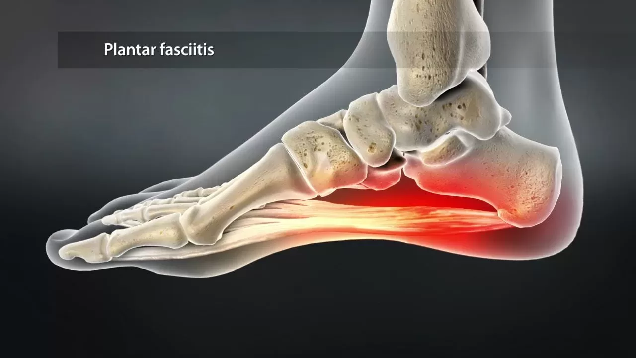 Plantar fasciitis is a common heel problem which causes pain.
