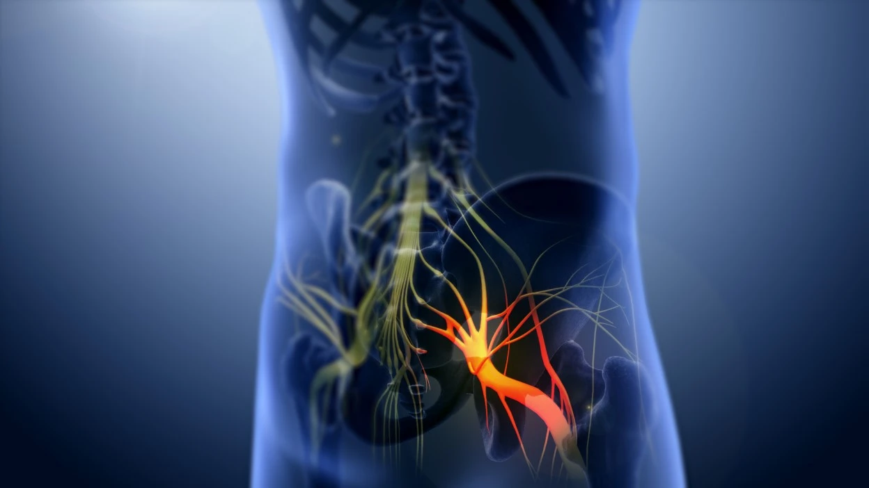 sciatica refers to inflammation of the sciatic nerve which is a peripheral nerve that runs down the back of each leg.