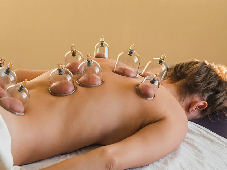 Cupping therapy is an ancient treatment method using cups to pull skin away from underlying tissues.