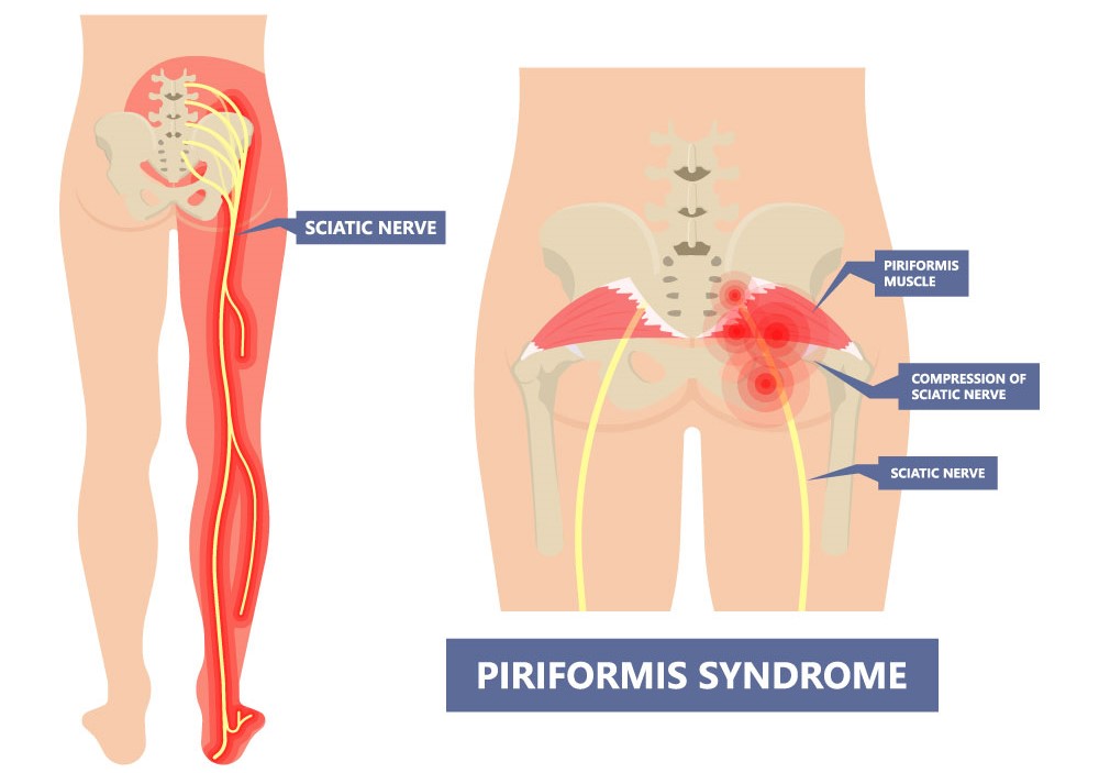 The piriformis syndrome is feeling numbness in the piriformis muscle near the sciatic nerve.