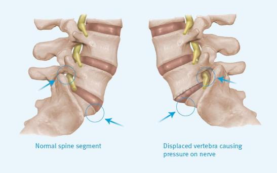 Spondylolisthesis is a very common cause of sciatica and is caused when the vertebrae slips against its adjacent level.