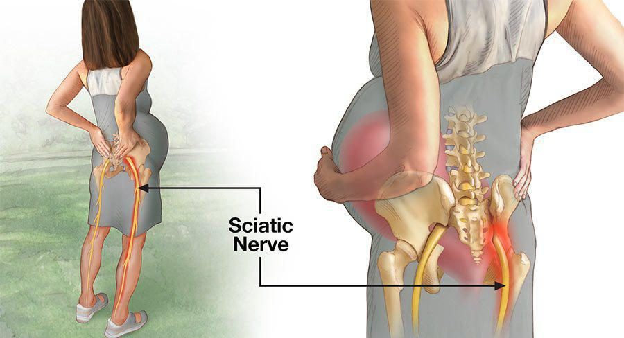 Sciatica and Sciatic Nerve Pain