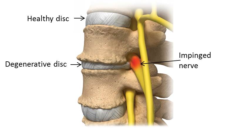 Degenerative Disk Disease or DDD is a common cause of sciatica and is occurred when disks lose their height.