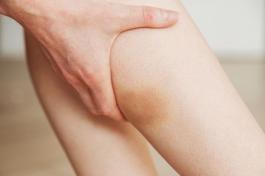 Minor bruising may happen due to chiropractic treatment; however, it's so rare and goes away on its own.