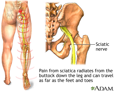The sciatic nerve travels behind the leg and further branches into the peroneal nerves and any inflammation of the nerve can cause sciatica pain.