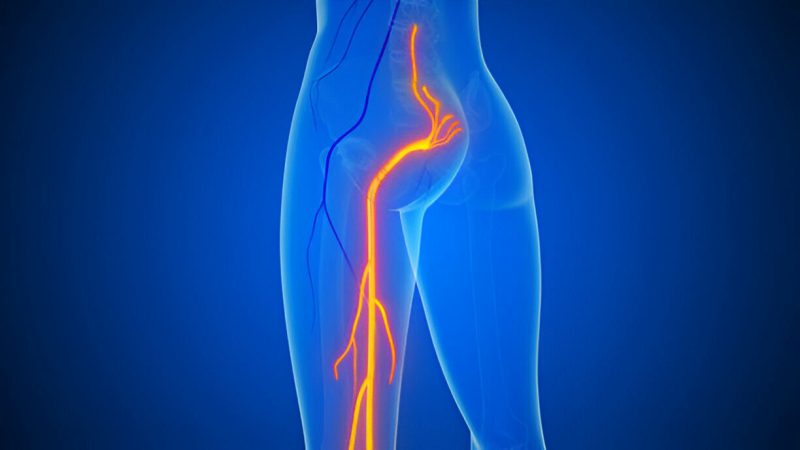 Sciatica, Piriformis Syndrome, or Disc Herniation